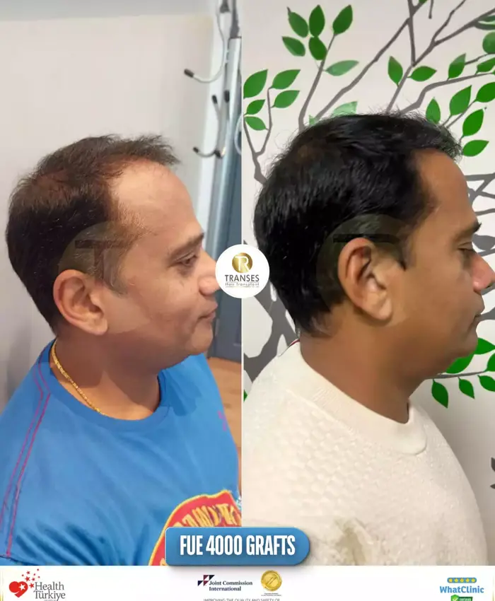 Before & After