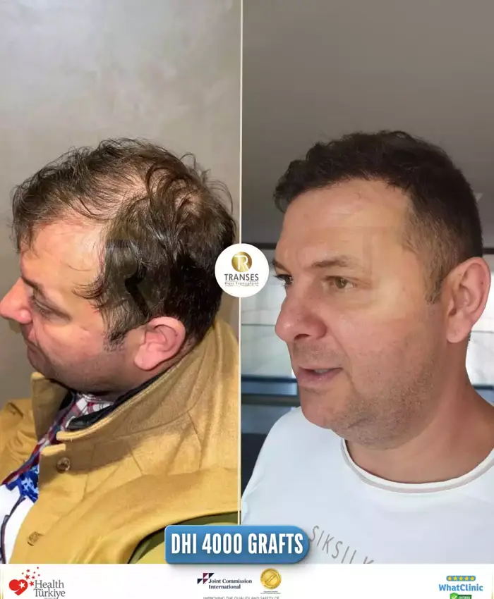 Before & After