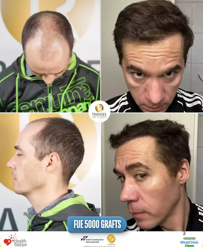 Before & After