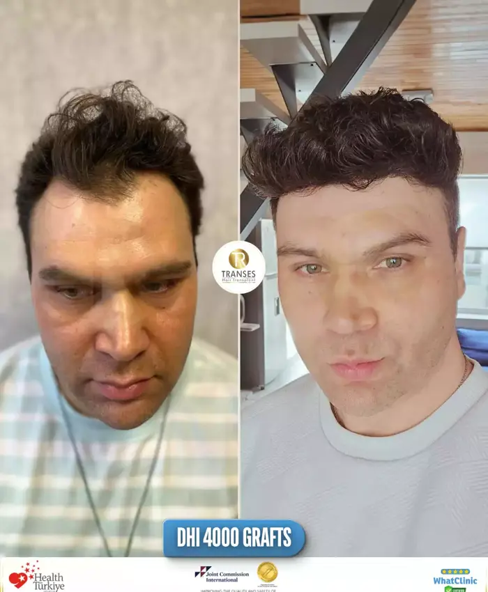 Before & After