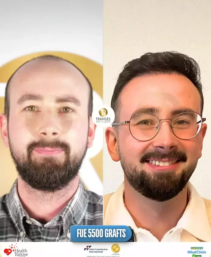 Before & After