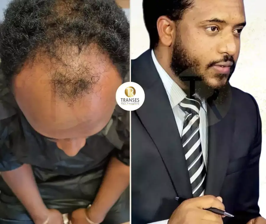 Afro Hair Transplant
