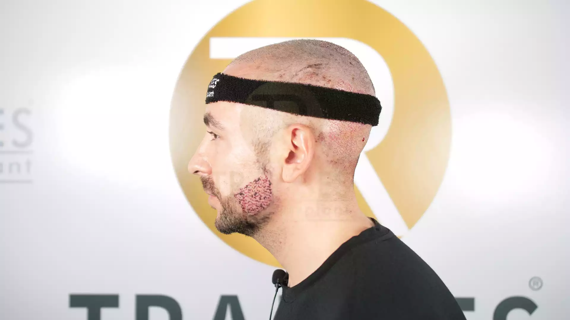Bart- und Schnurrbarttransplantation