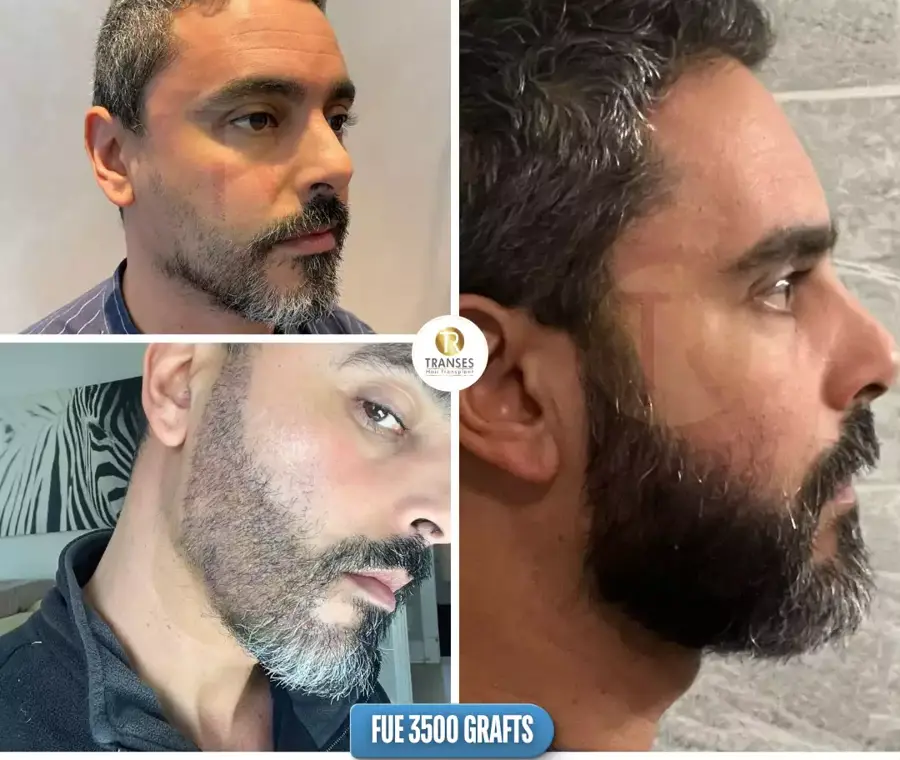Beard Transplant