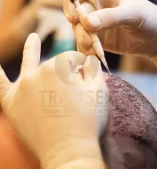 DHI (Direct Hair Implant)