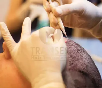 DHI (Direct Hair Implant)