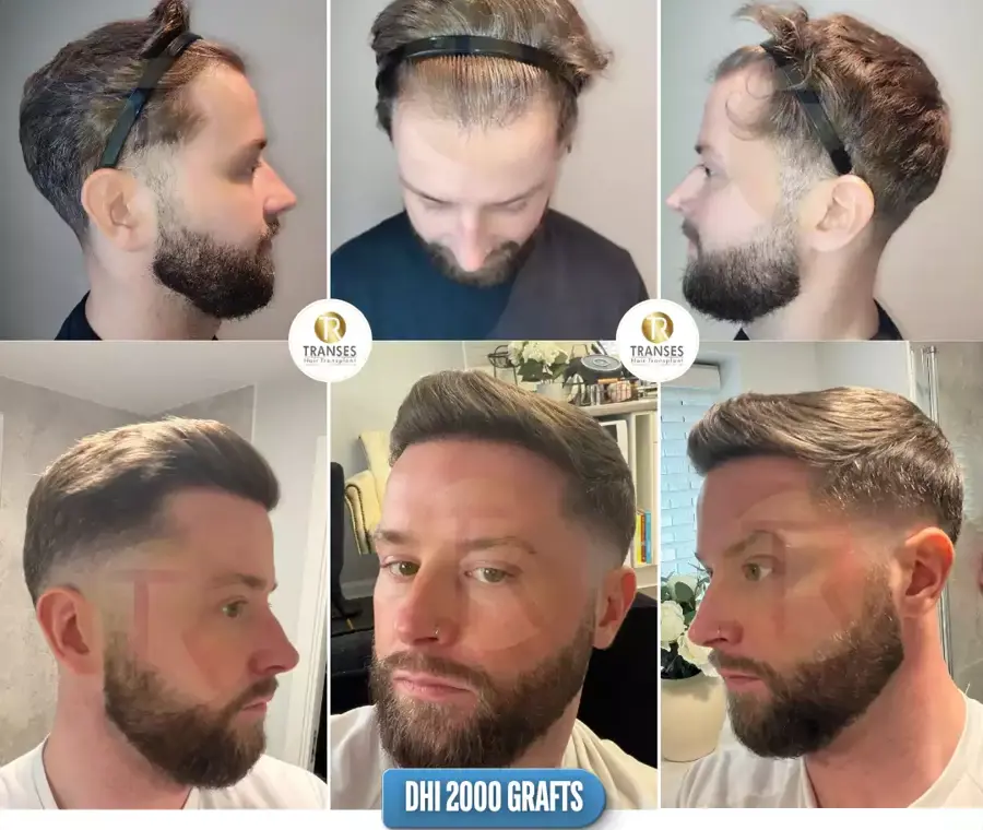 DHI Direct Hair Transplant 