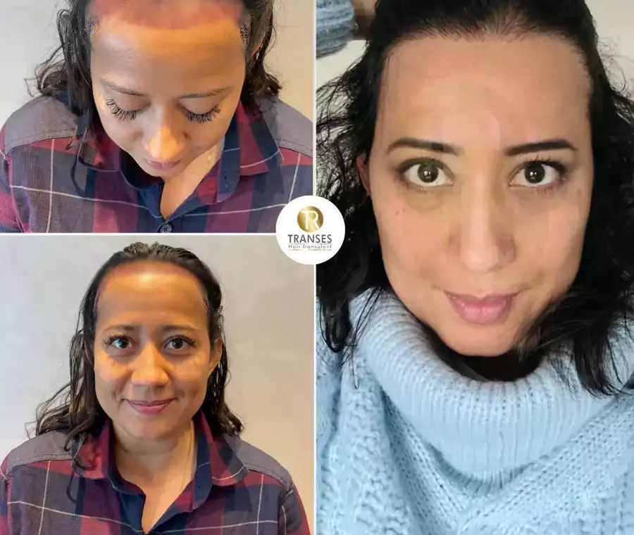 DHI Direct Hair Transplant 
