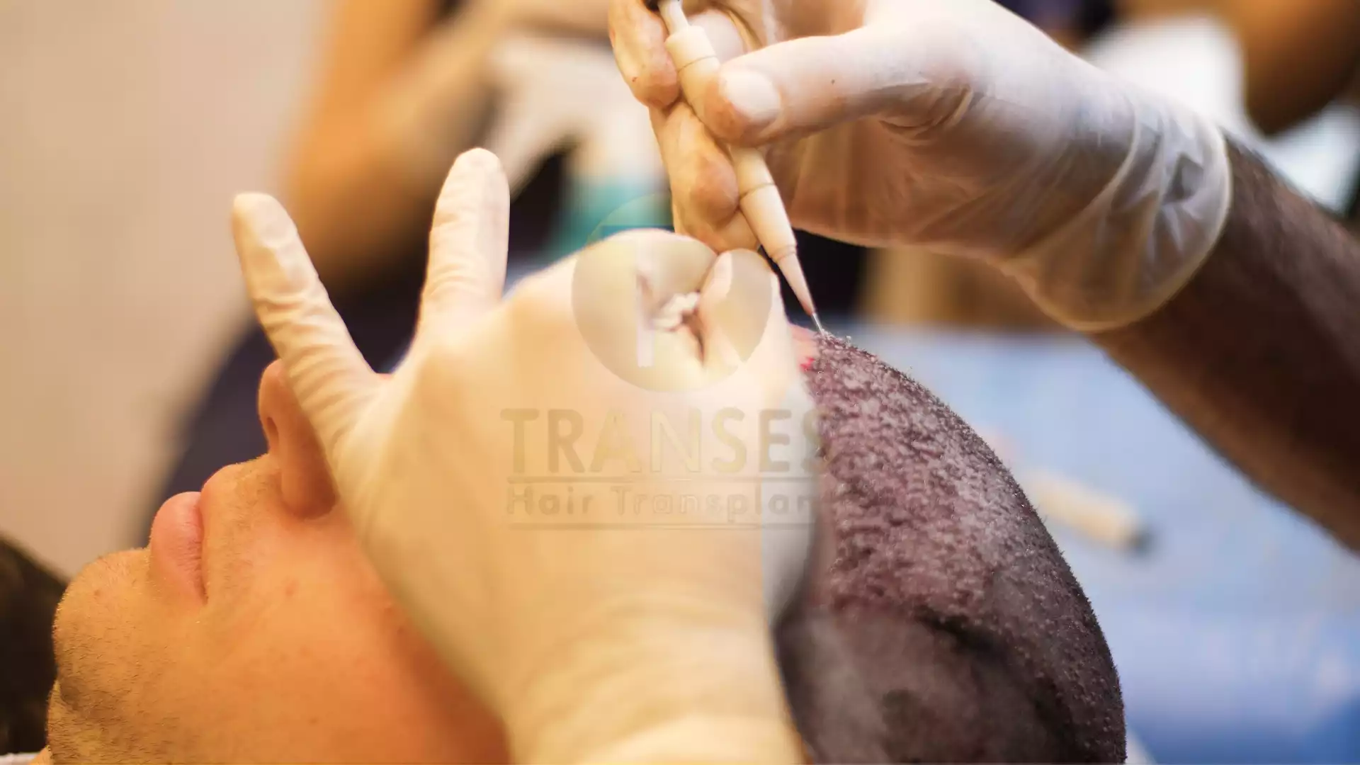 DHI (Direkte Haarimplantation)