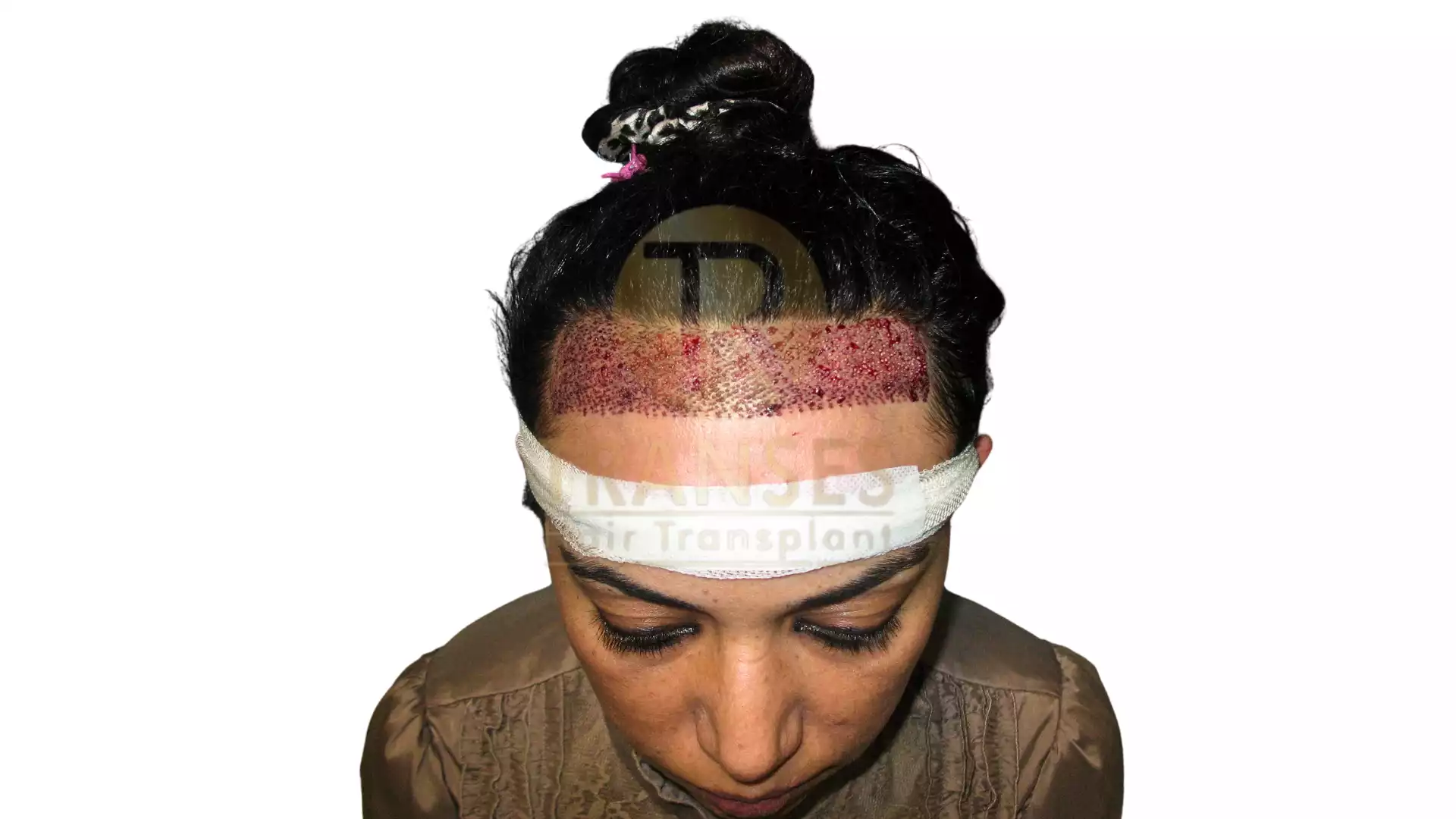 Hair Transplant for Women