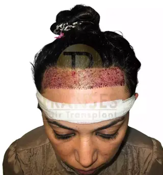 Hair Transplant for Women
