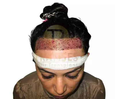 Hair Transplant for Women