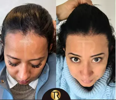 Hair Transplant for Women