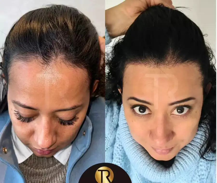 Hair Transplant for Women