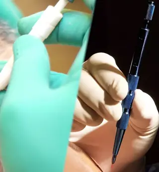 Hybrid Hair Transplant