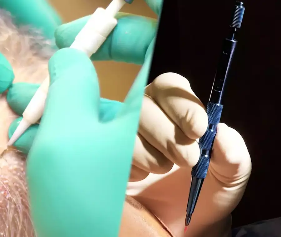 Hybrid Hair Transplant