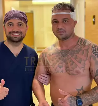 No Shave Hair Transplant