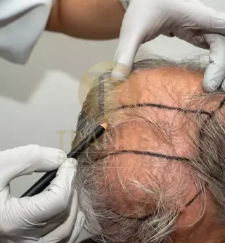 Percutaneous Hair Transplantation