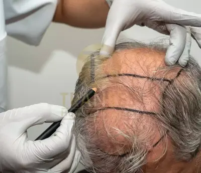 Percutaneous Hair Transplantation
