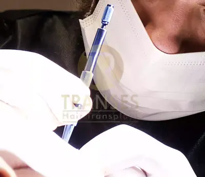 Sapphire FUE Hair Transplant