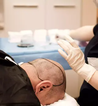 Yara İzine Saç Ekimi